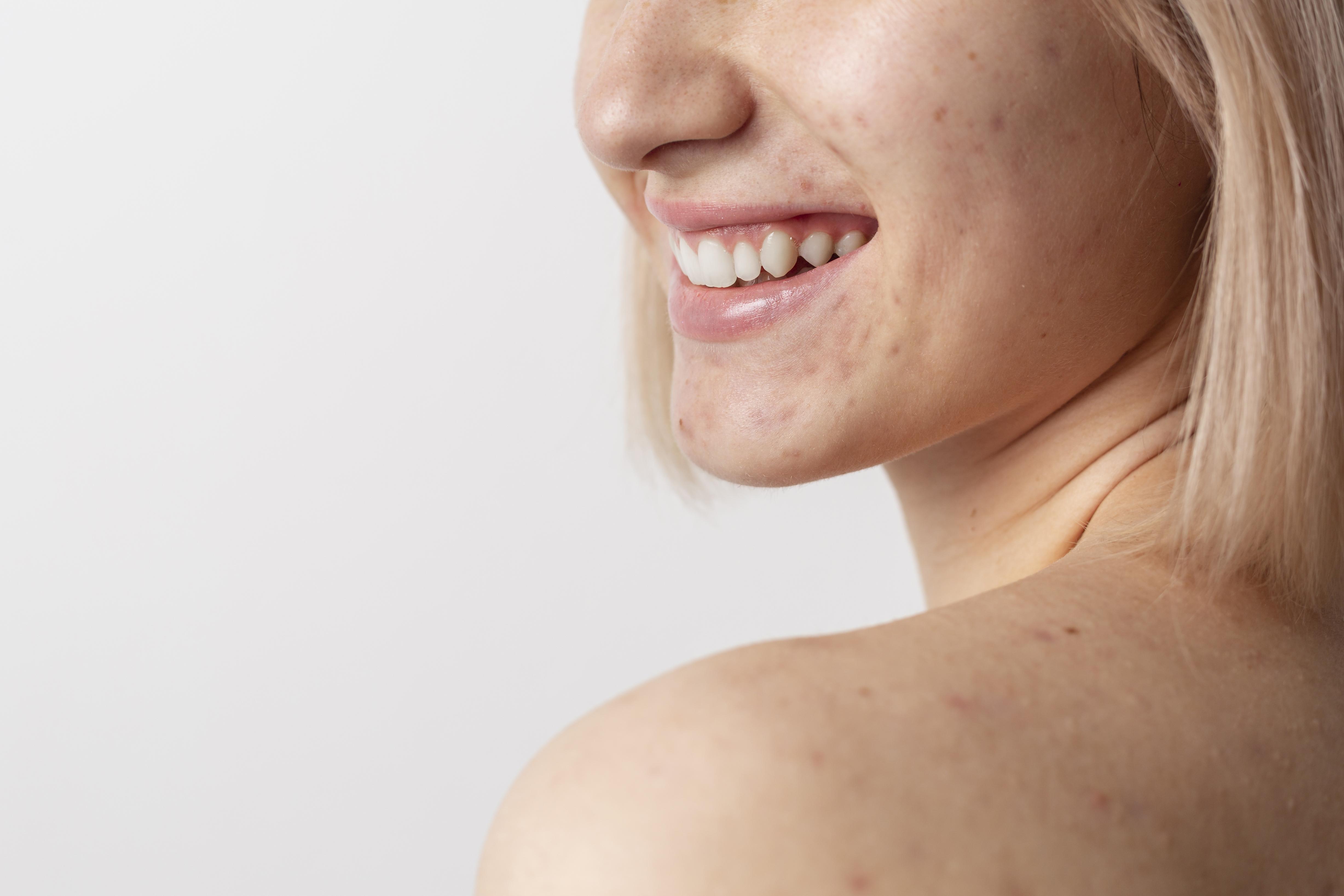 Acne Care Plus treatment