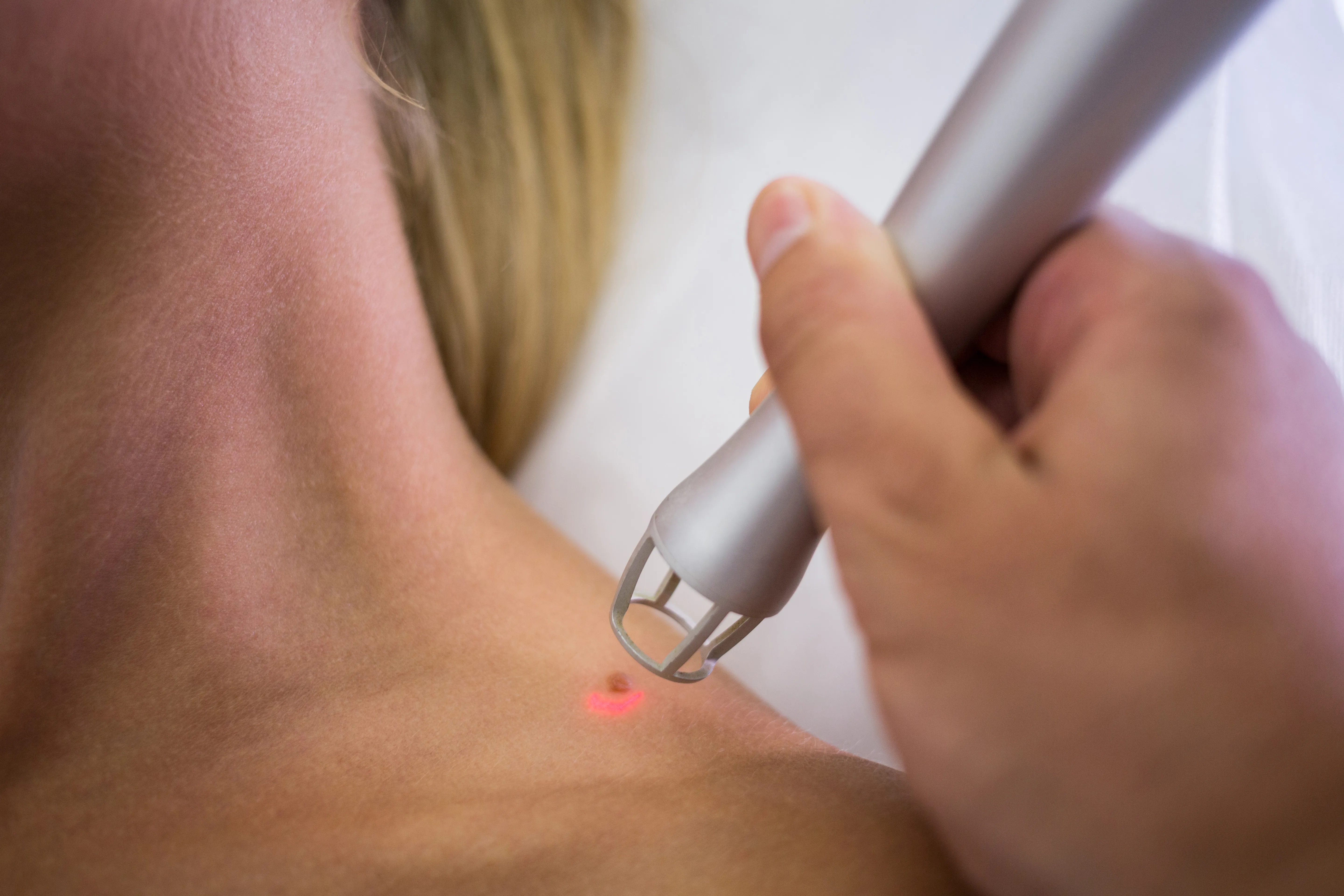 Warts and Mole Removal treatment