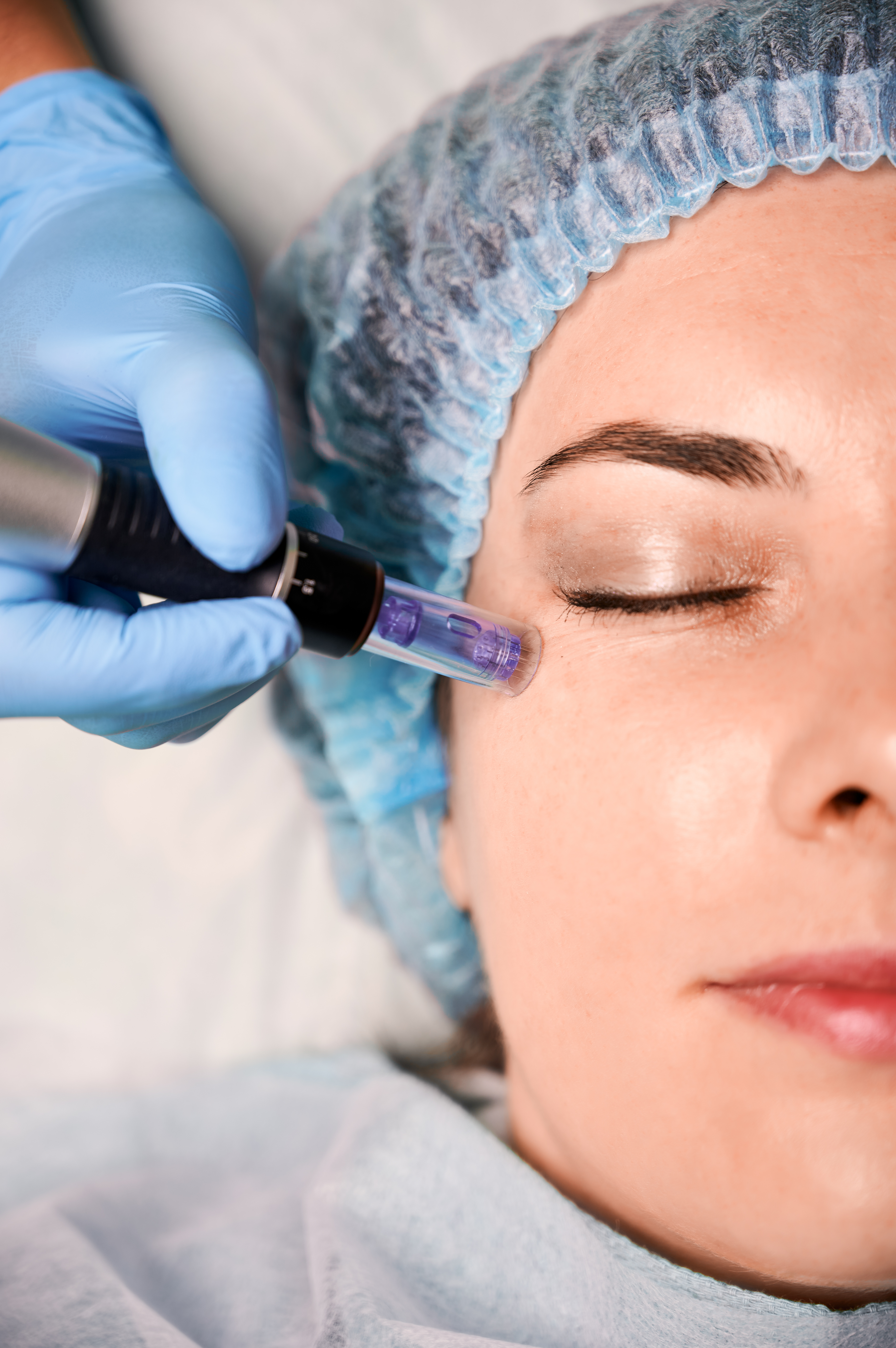 Exosomes Microneedling Image 3